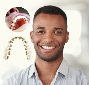 Tips To Avoid Tooth Decay While Wearing Braces Or Aligners